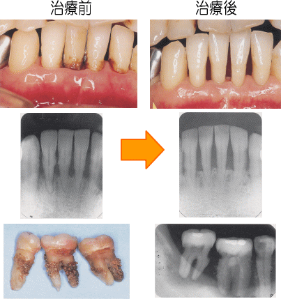 歯周病の治療前と治療後