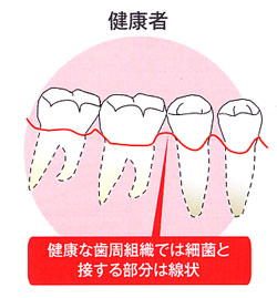 歯周病患者の歯の様子