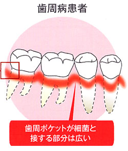 歯周病患者