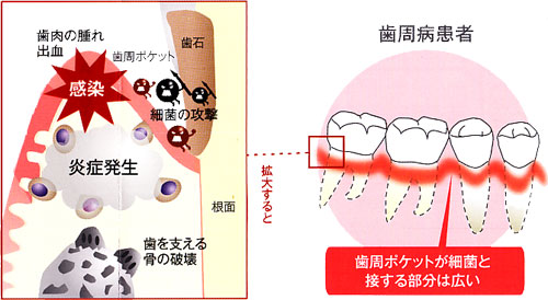 歯周ポケットの拡大図